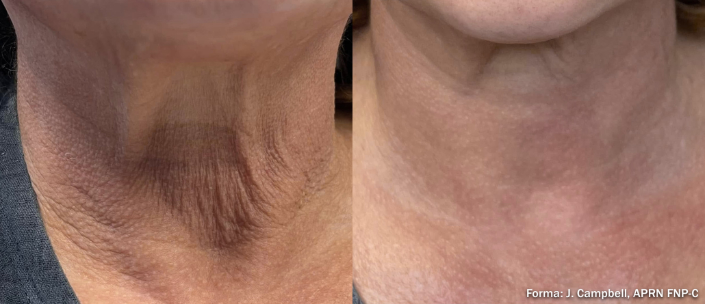 Before treatment