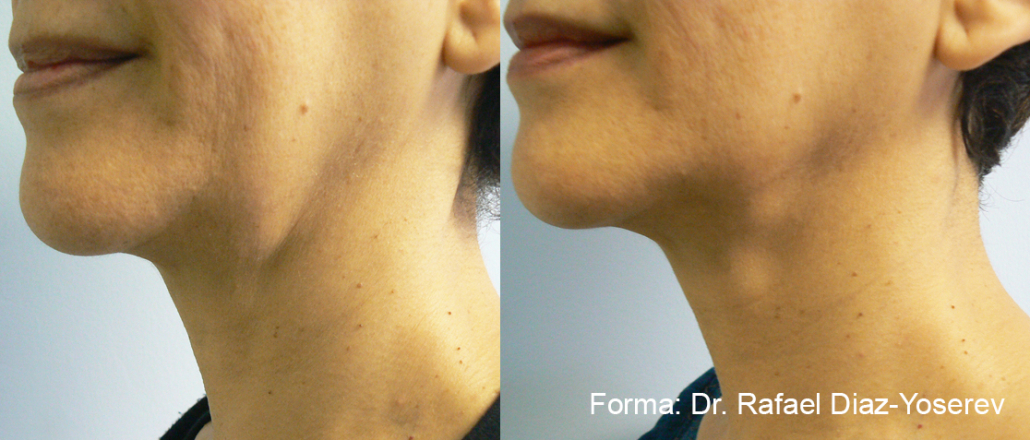 Before treatment