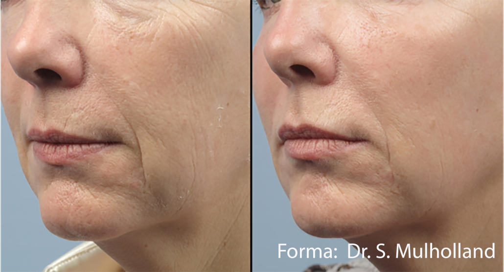 Before treatment