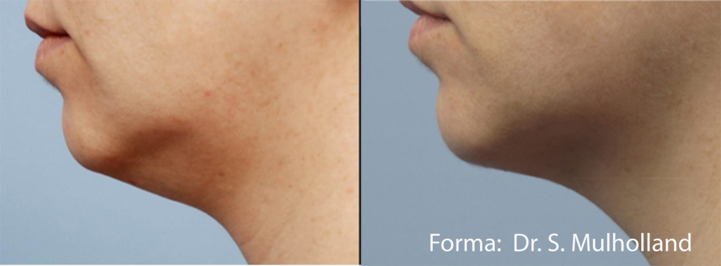 Before treatment