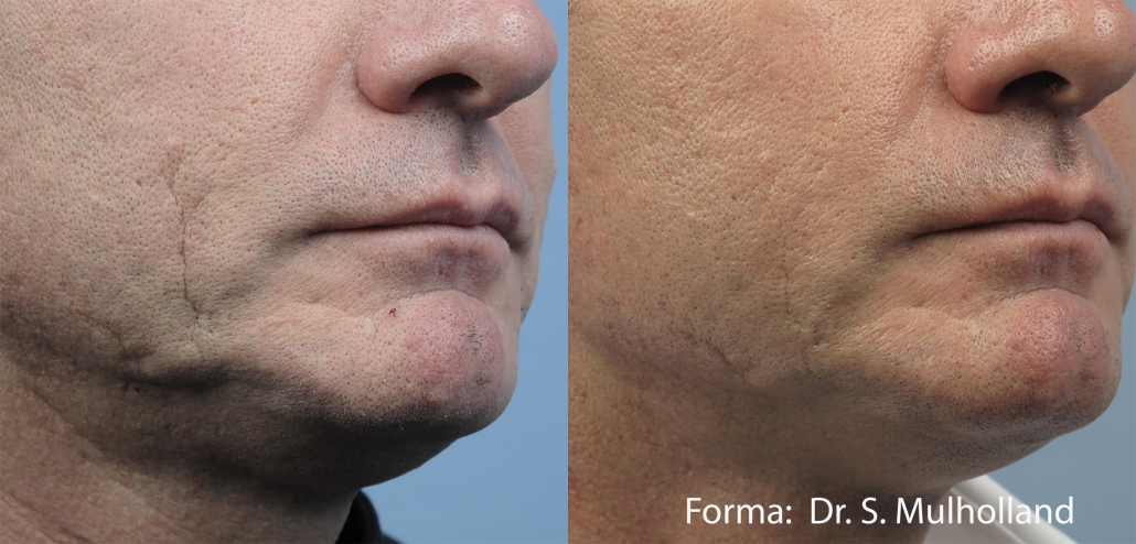 Before treatment