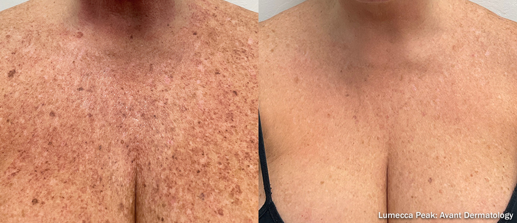 Before treatment
