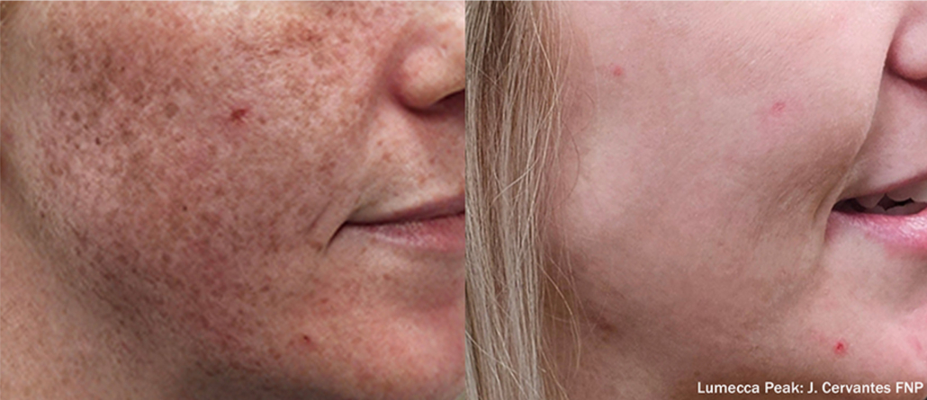 Before treatment